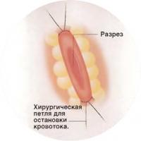 Разрез длиной 1 см в месте шунтирования