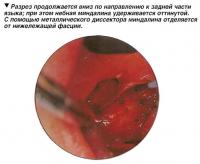 Разрез продолжается вниз по направлению к задней части языка