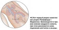 Разрез Резерфорда -Моррисона