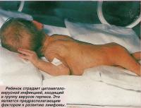 Ребенок страдает цитомегаловирусной инфекцией, входящей в группу вирусов герпеса