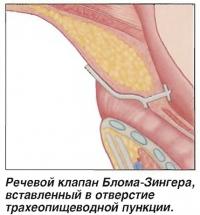Речевой клапан Блома-Зингера, вставленный в отверстие трахеопищеводной пункции