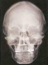 Рентгенограмма черепа