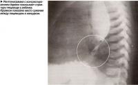 Рентгенограмма с контрастированием барием показывает стриктуру пищевода у ребенка