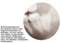 Рентгеновский снимок нижнего левого зуба мудрости