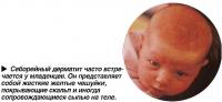 Себорейный дерматит часто встречается у младенцев