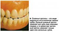 Съемные протезы - это индивидуально изготовленная замена зубов
