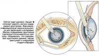 Сейчас ядро удалено. Хирург начинает удалять мягкое содержимое хрусталика