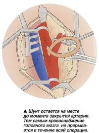 Шунт остается на месте до момента закрытия артерии