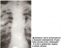 Силикоз часто встречается у бывших камнерезов