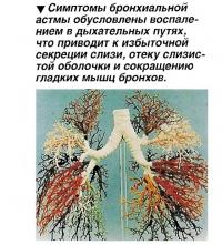 Симптомы бронхиальной астмы обусловлены воспалением в дыхательных путях