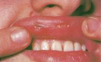 Синдром Бехчета характеризуется появлением язв в области рта и гениталий