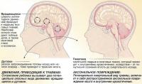Синдром сотрясенного ребенка