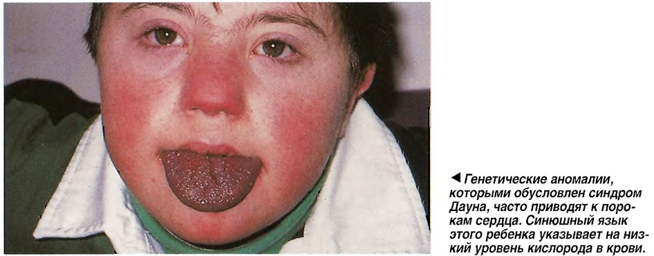Синюшный язык этого ребенка указывает на низкий уровень кислорода в крови