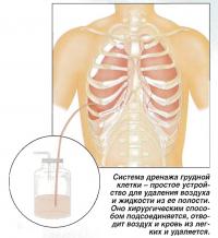 Система дренажа грудной клетки