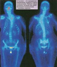 Сколиоз - это врожденное искривление грудного отдела позвоночника