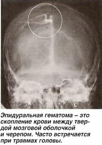 Скопление крови между твердой мозговой оболочкой и черепом