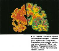Сравнение мозга пациента с болезнью Альцгеймера (слева) и здоровый мозг (справа)