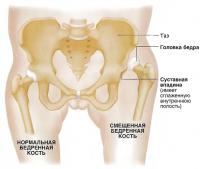Сравнение нормального и смещенного бедра
