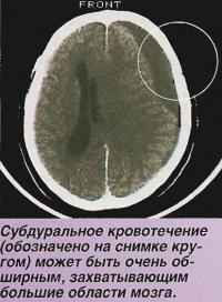 Субдуральное кровотечение может быть очень обширным