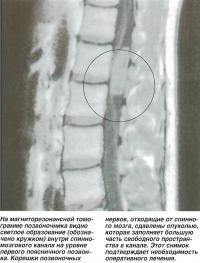 Светлое образование внутри спинномозгового канала