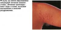 Сыпь на плече обусловлена миграцией личинок анкилостомы