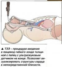 ТЭЭ - процедура введения в пищевод гибкого зонда