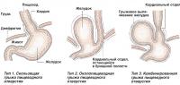 Типы грыжи пищеводного отверстия диафрагмы
