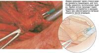 Трахеопищеводная пункция для восстановления голоса