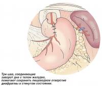 Три шва помогают сохранить пищеводное отверстие диафрагмы в стянутом состоянии