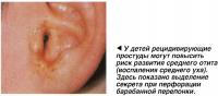 У детей рецидивирующие простуды могут повысить риск развития среднего отита