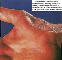 У пациента с синдромом карпального канала имеется ямка у основания большого пальца кисти