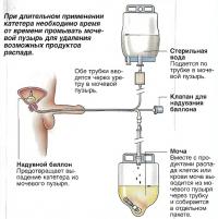 Уход за катетером