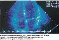 Ультразвуковая картина четырех камер сердца