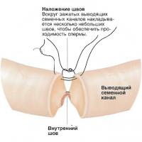 Устранение вазэктомии