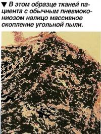 В этом образце тканей пациента с обычным пневмокониозом налицо массивное скопление угольной пыли