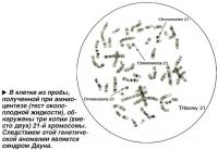 В клетке из пробы, полученной при амниоцентезе обнаружены три копии 21-й хромосомы