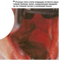 В конце этого этапа операции остается лишь тонкая полоска ткани