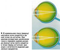 В нормальном глазу световые лучи сходятся в одной точке на сетчатке