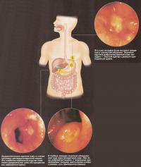 В поисках язв желудка
