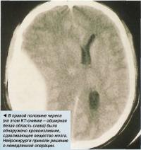 В правой половине черепа было обнаружено кровоизлияние