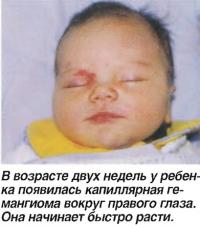 В возрасте двух недель появилась капиллярная гемангиома вокруг правого глаза