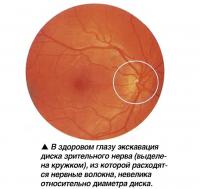 В здоровом глазу экскавация диска зрительного нерва невелика относительно диаметра диска