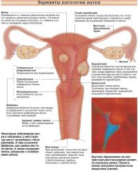 Варианты патологии матки