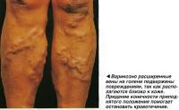 Варикозно расширенные вены на голени подвержены повреждениям, так как располагаются близко к коже