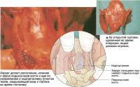 Вход в глотку и удаление гортани