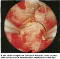 Вид через гистероскоп