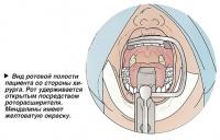 Вид ротовой полости пациента со стороны хирурга