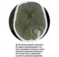 Видно кровоизлияние в левом полушарии головного мозга