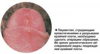Во время урологического обследования видны повреждения крайней плоти
