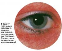 Вокруг глаз можно наблюдать красные или пурпурные высыпания